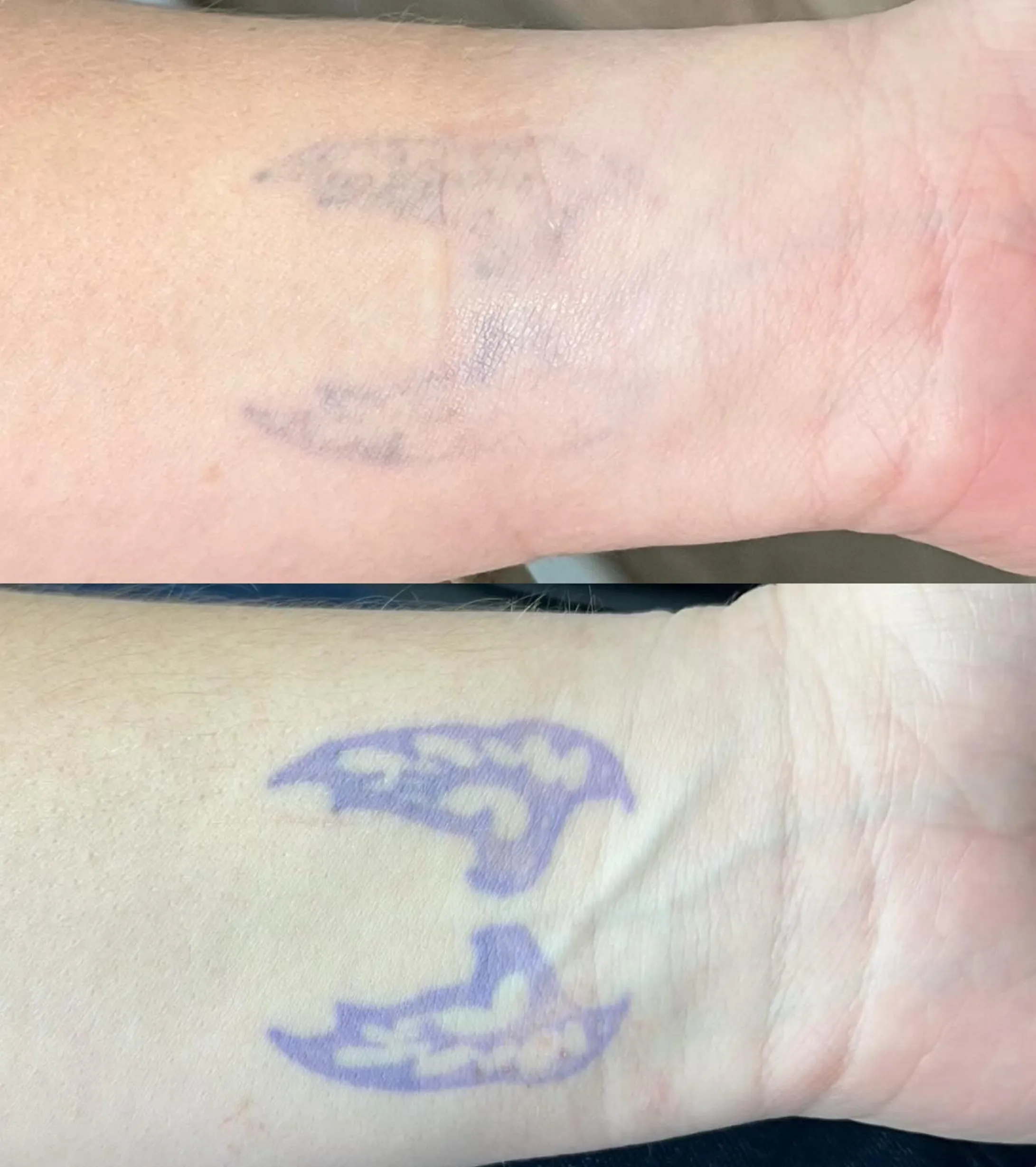 does ink come out in urine after tattoo removal
