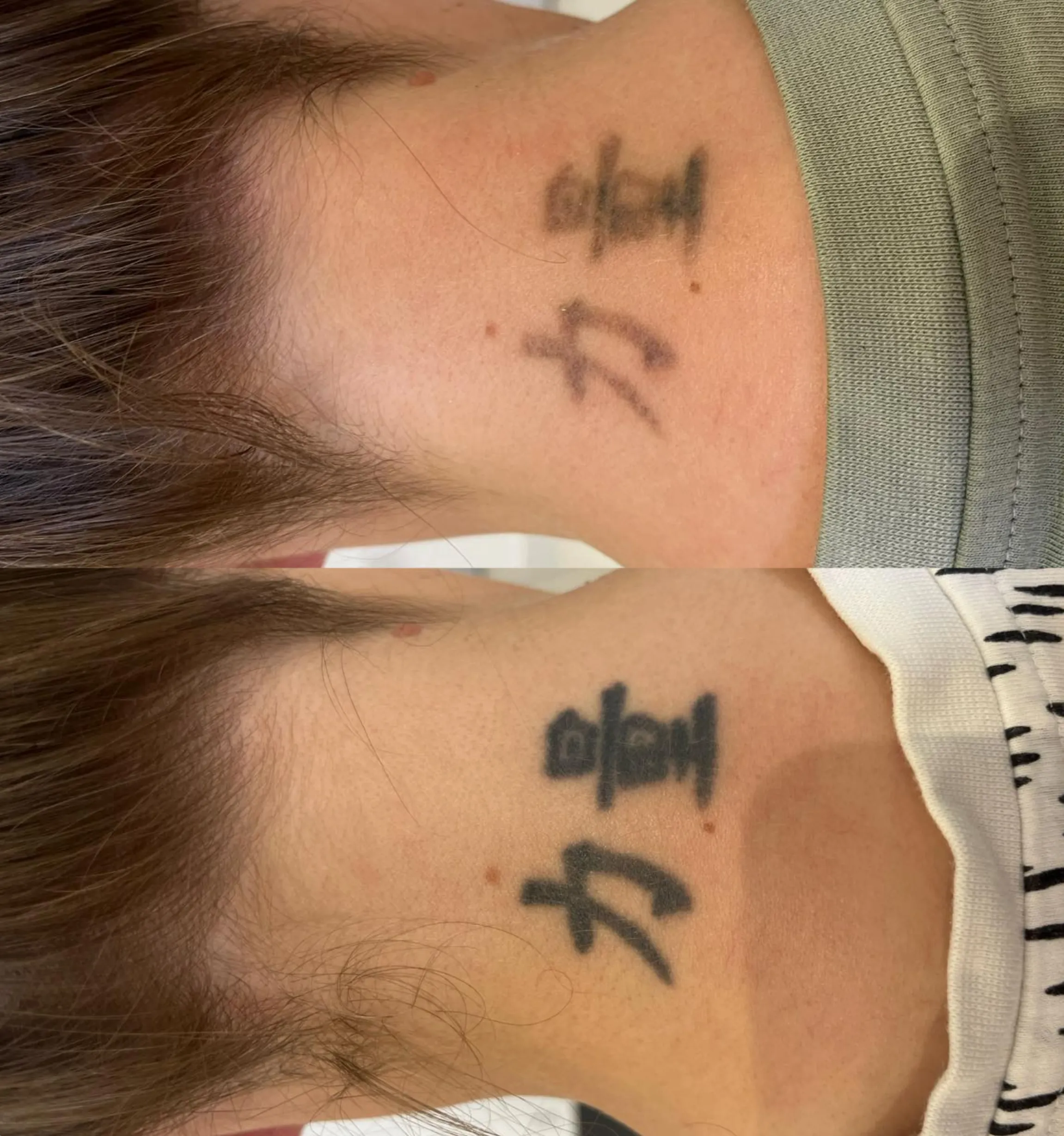 laser eyebrow tattoo removal process