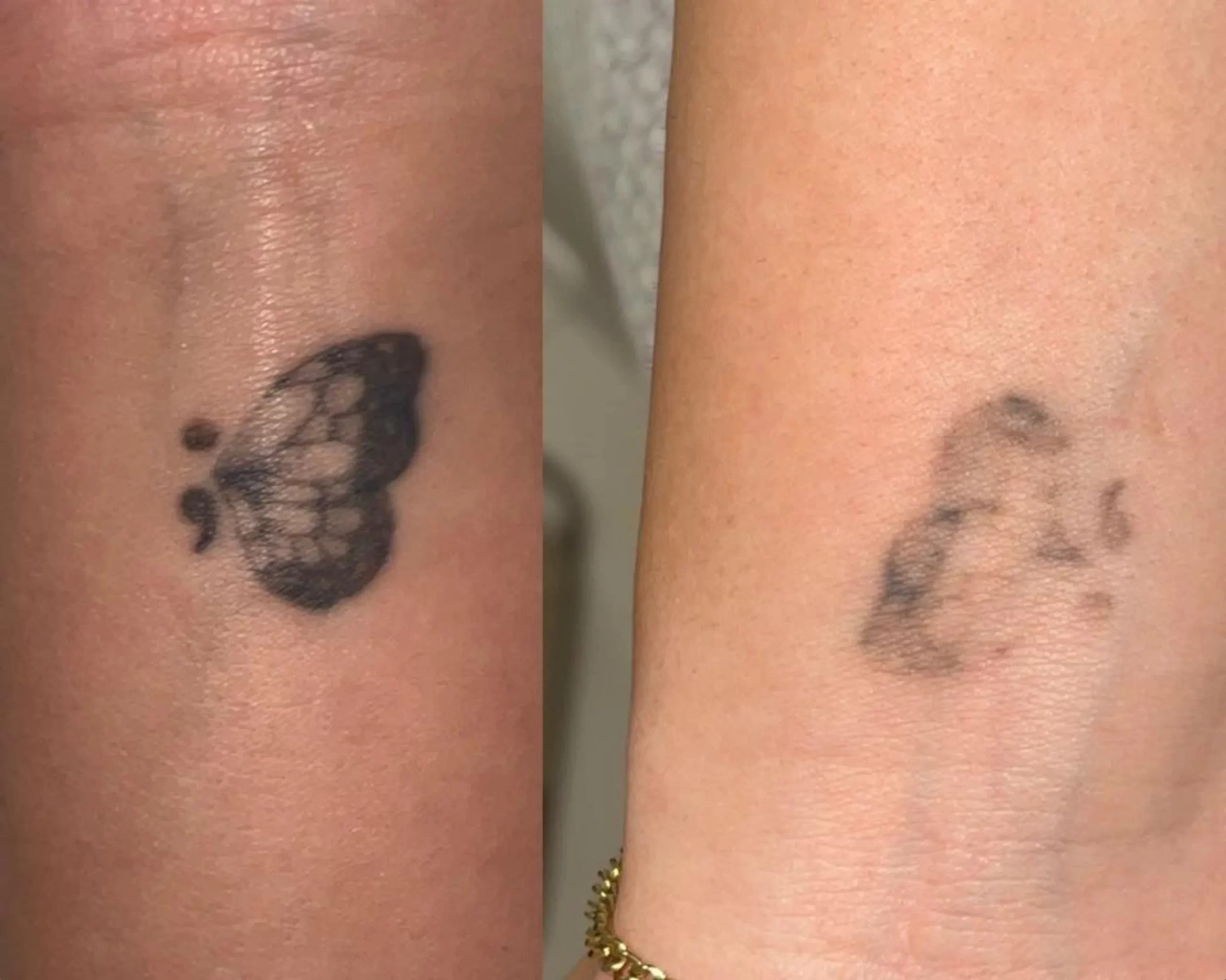 laser tattoo removal healing timeline
