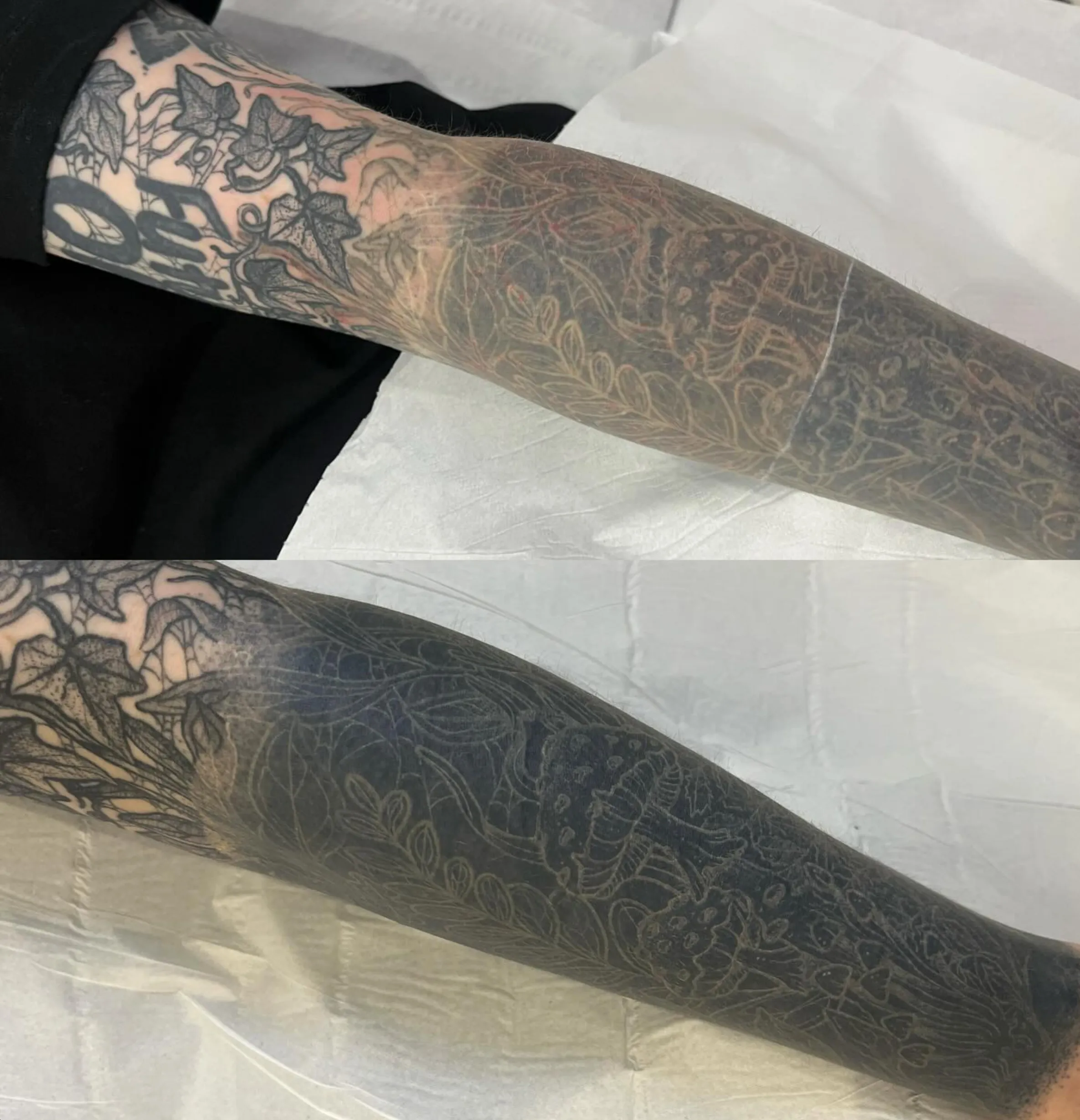 immune system and tattoo removal
