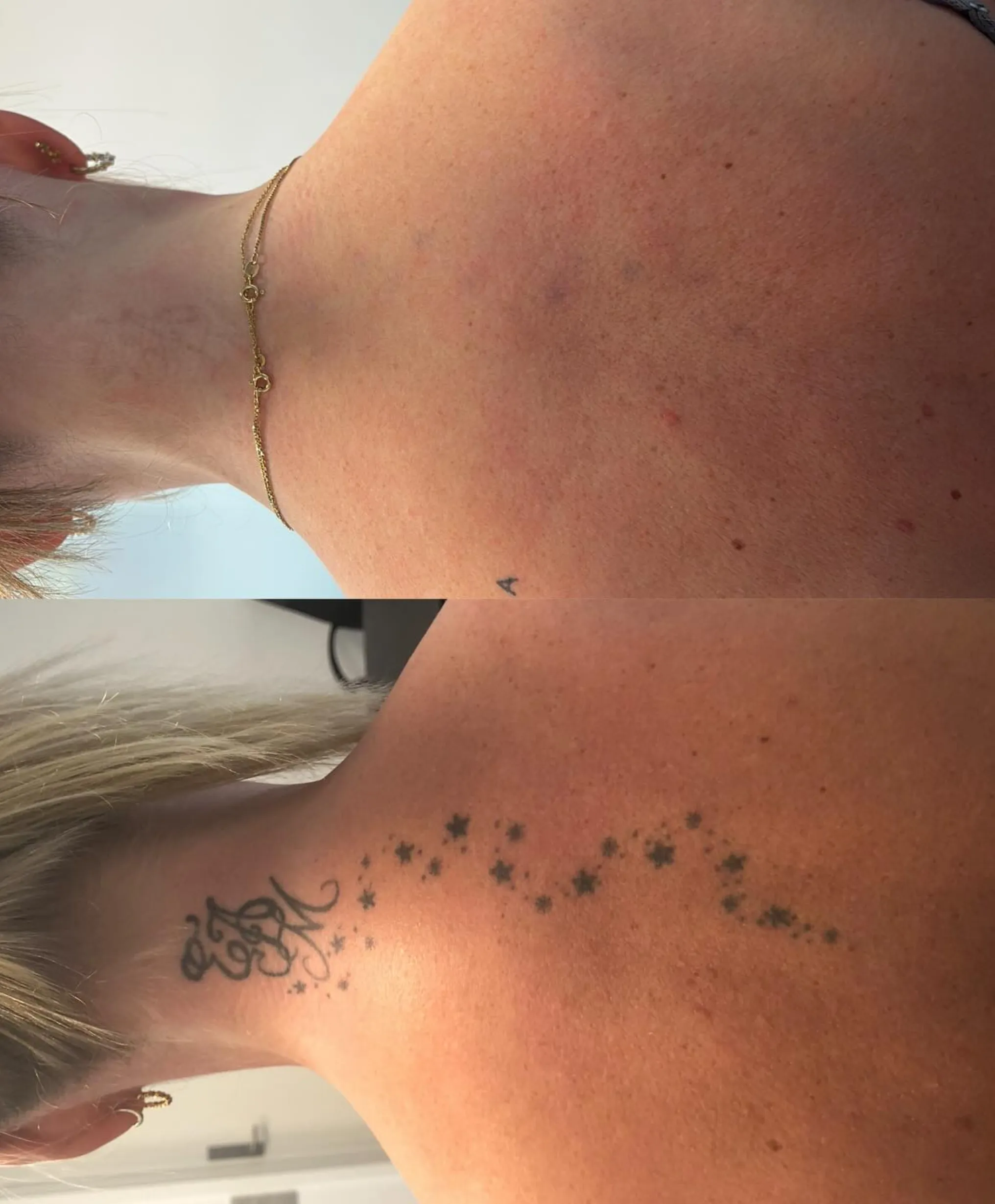 how does the body remove tattoo ink